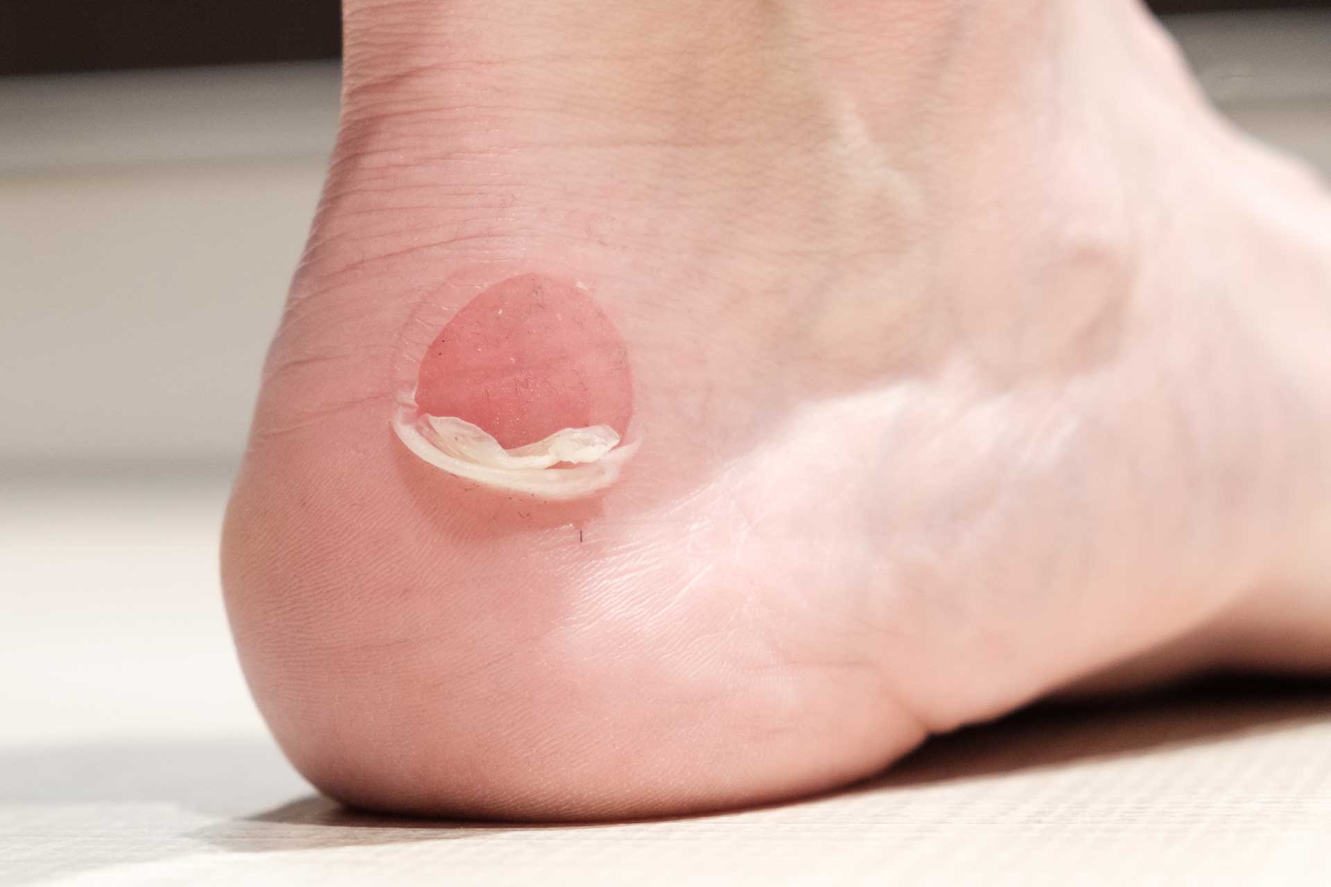 Understanding Foot Blisters Algeos